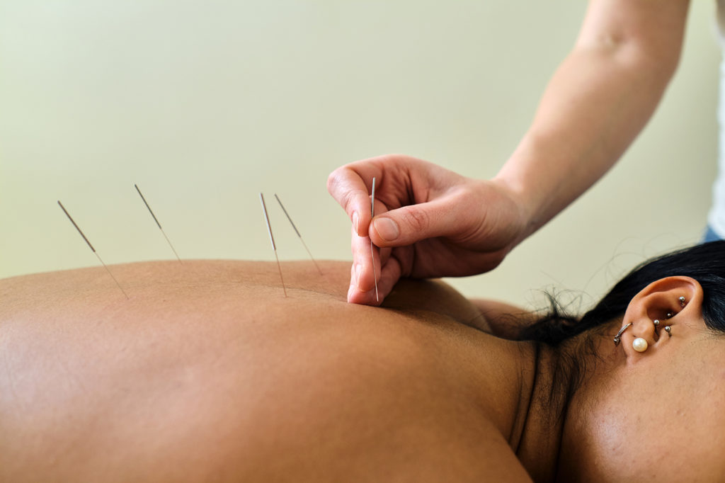 acupuncture-treatment-worthing