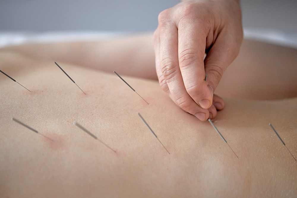 acupuncture-treatment-protocol-anxiety