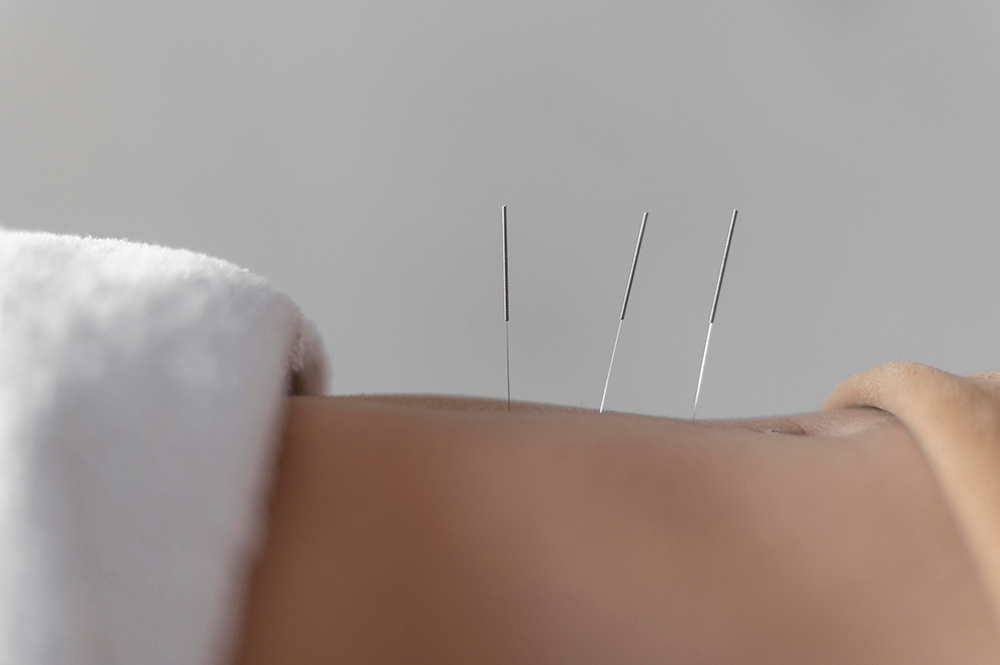 acupuncture-procedure