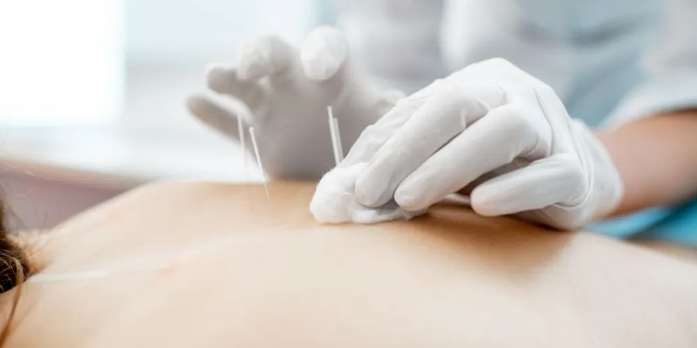 Acupuncture in Worthing